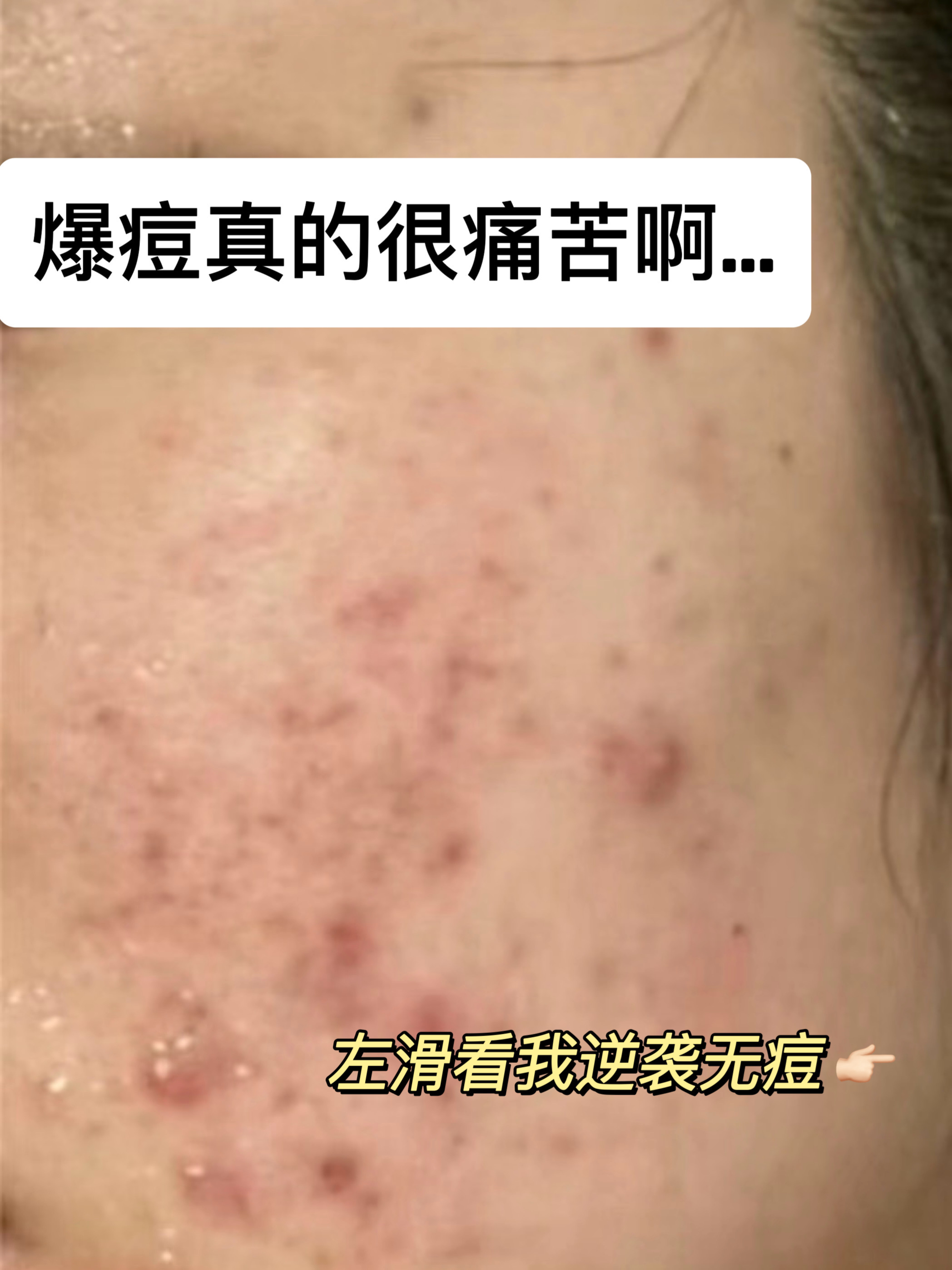 人为什么长痘痘的原因百科在线