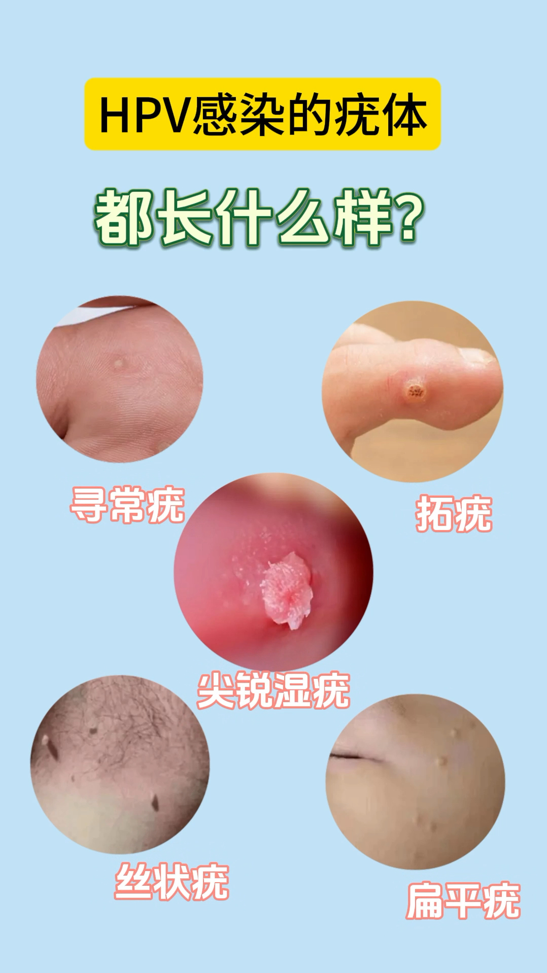 hpv感染的疣体都长什么样子?快来检查一下自己吧!