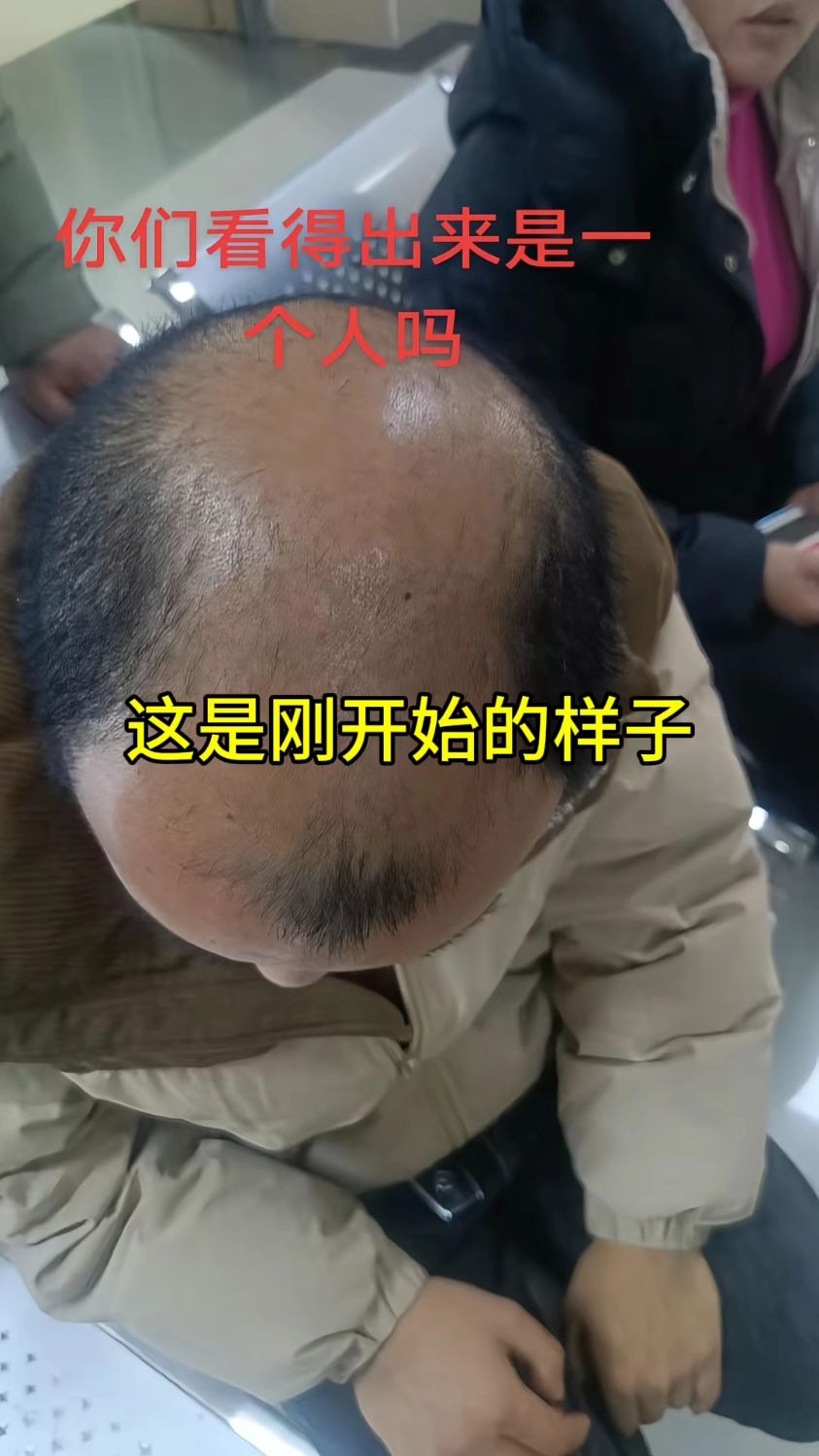 脱发前后对比,秃顶显老