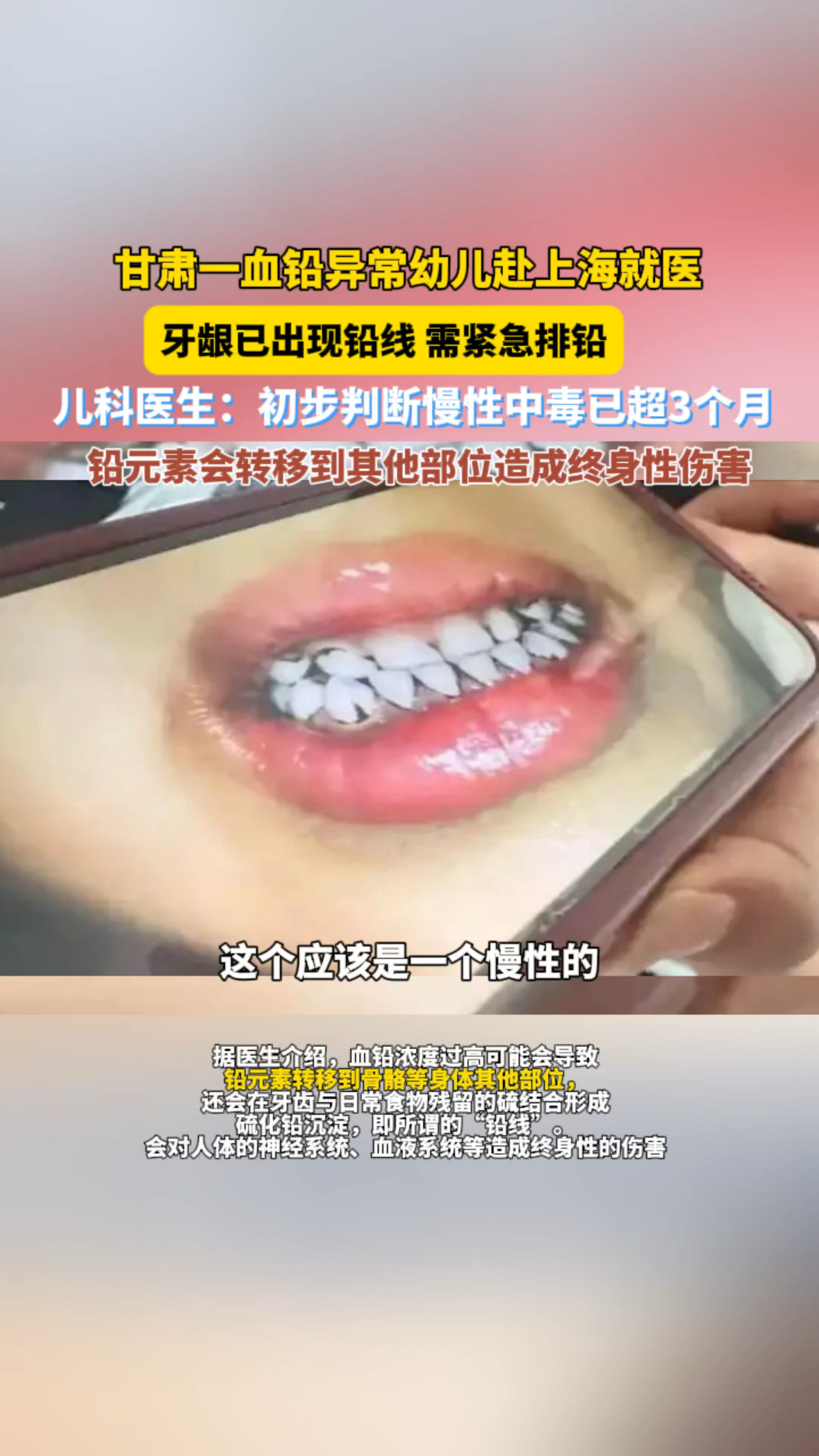 血铅异常幼儿已出现牙龈铅线 初步判断慢性中毒3个月