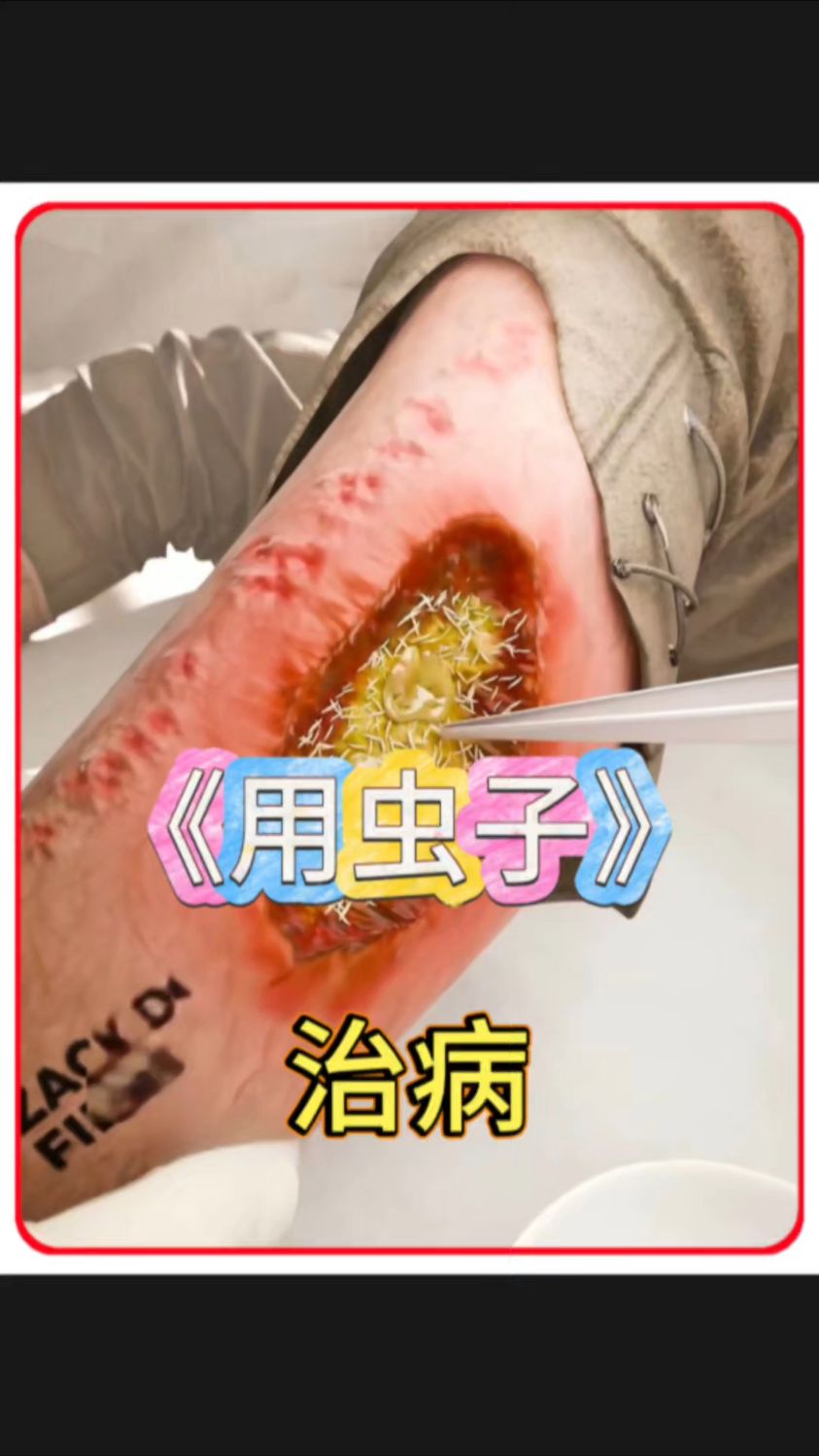 二战时期的军人用蛆治疗伤口