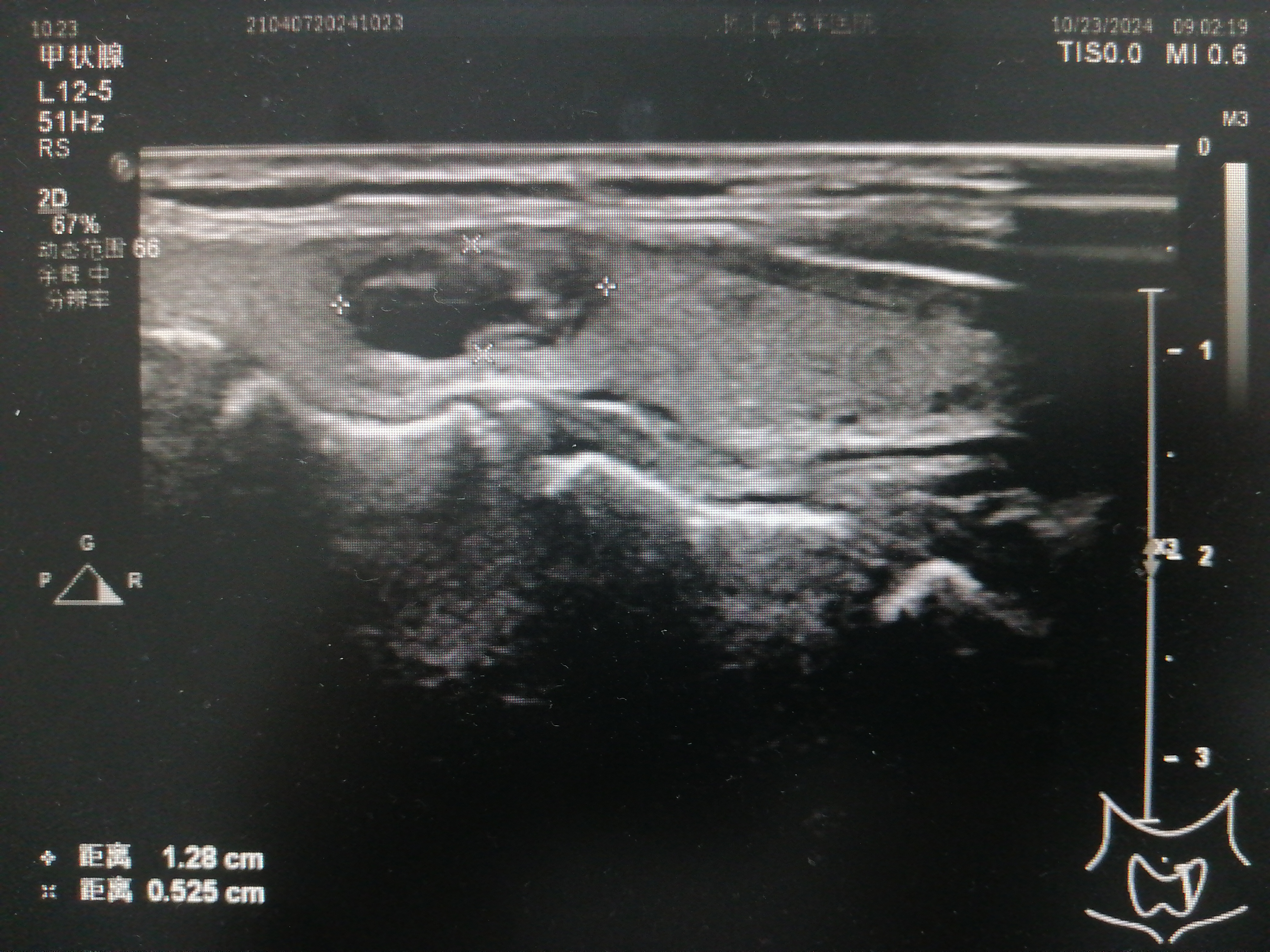 双侧甲状腺多发结节 c