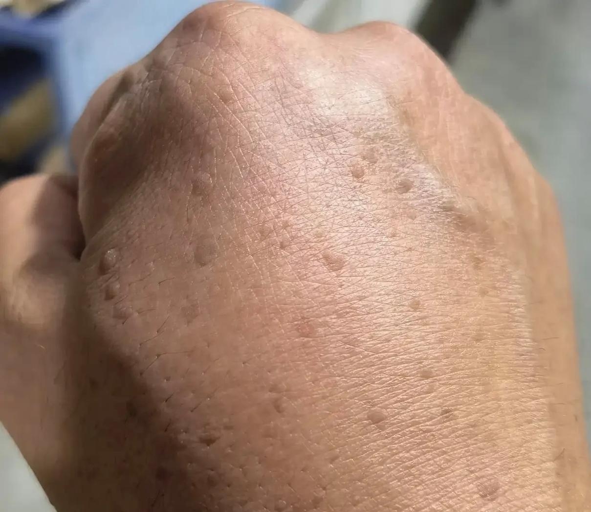 医生说这是疣,不会传染,还给