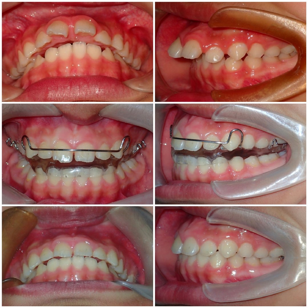 新齿佳正畸活动矫治器