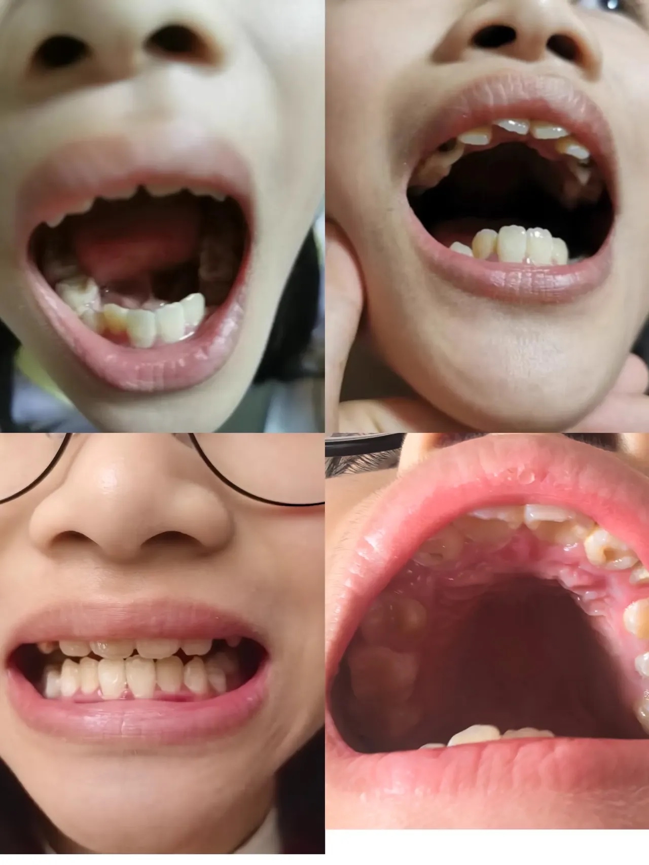 小孩牙齿倒长的图片小孩牙齿长歪了图片儿童牙齿牙齿外翻图片儿童牙齿