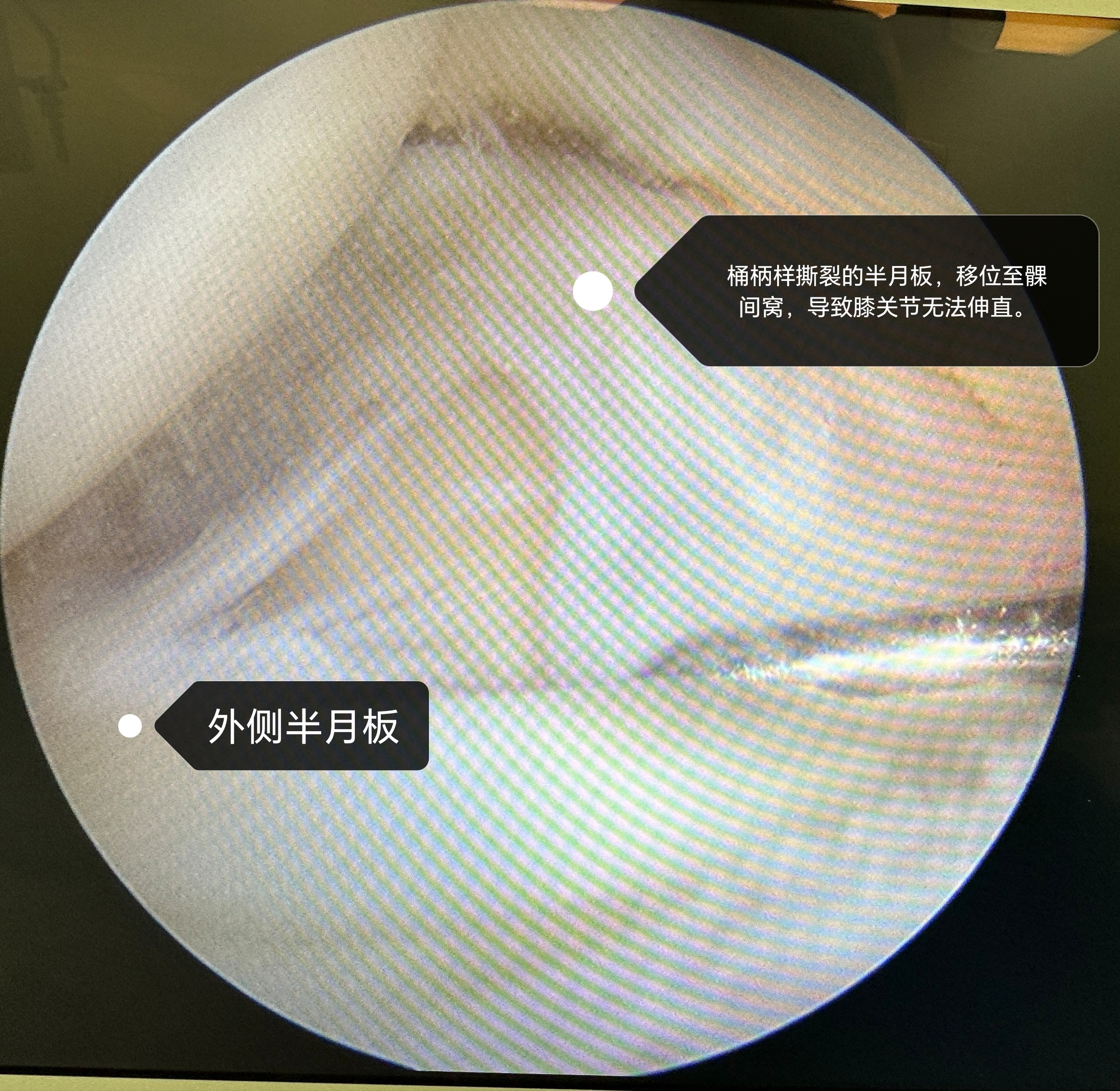 50岁男性,半月板撕裂5年,撕裂的半月板卡在髁间窝,导致膝关节5年来