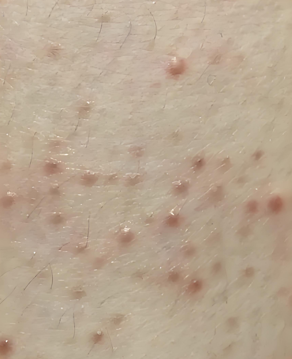 为什么鸡皮肤会越来越多百科在线