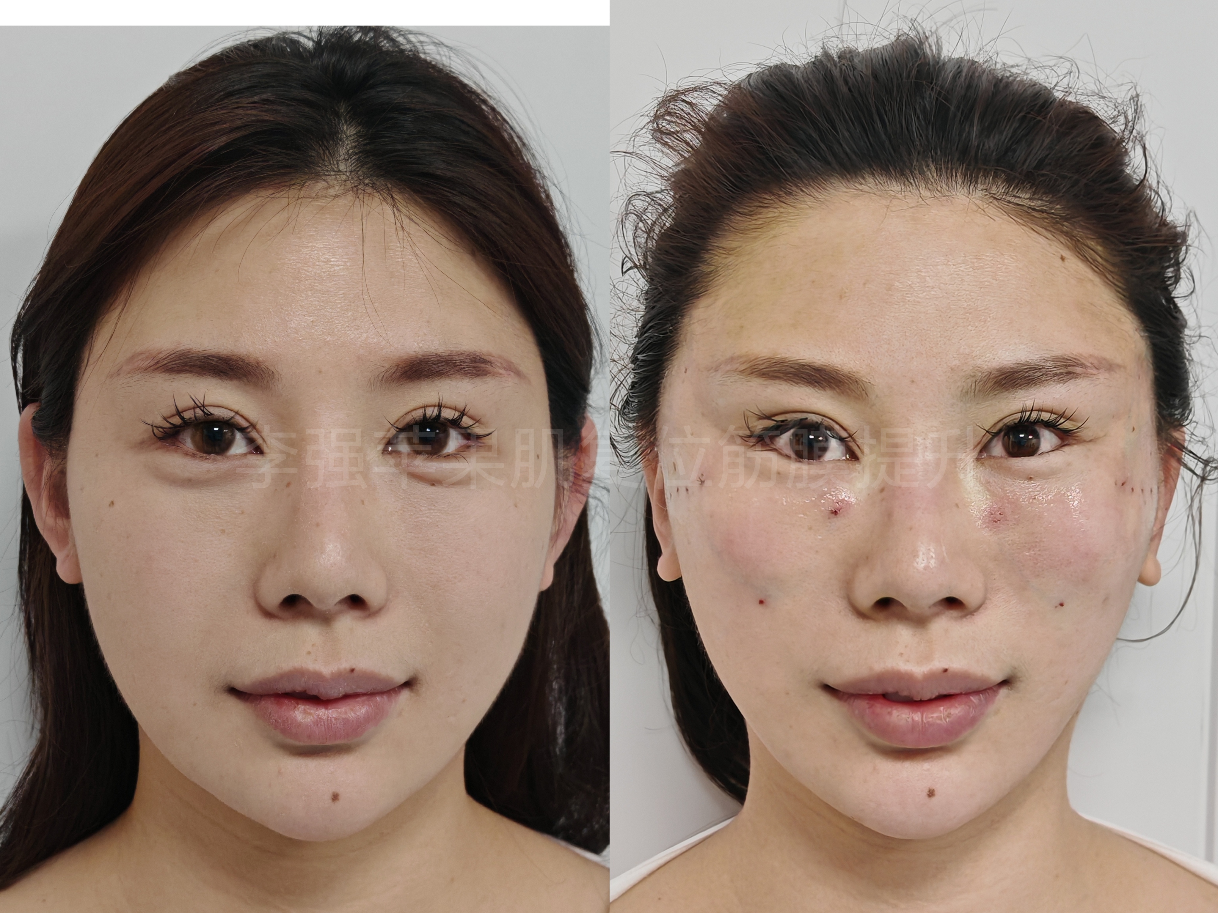 苹果肌复位筋膜提升术后 苹果肌复位筋膜提升术后即刻