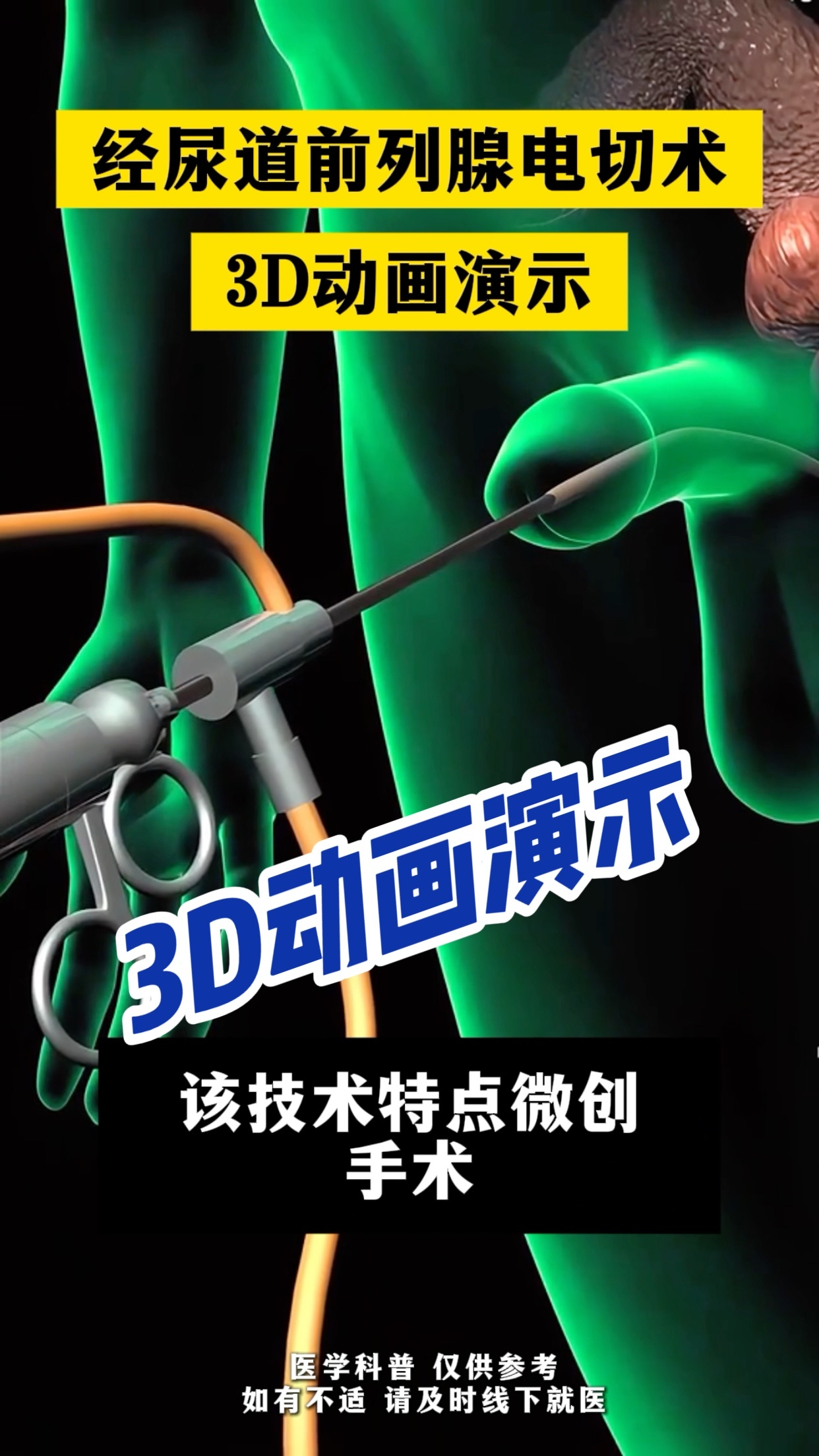 经尿道前列腺电切术3d动画演示