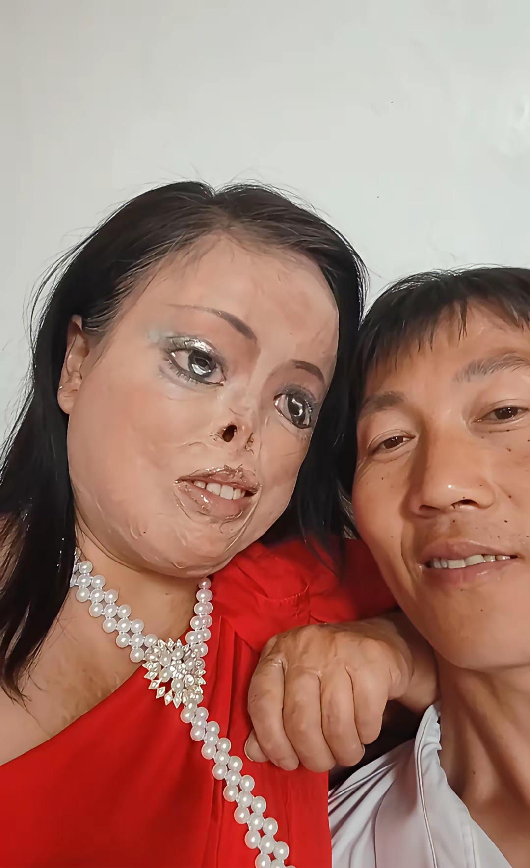还能积极面对被硫酸泼到皮肤图片脸上泼了硫酸的脸照片硫酸泼脸上的
