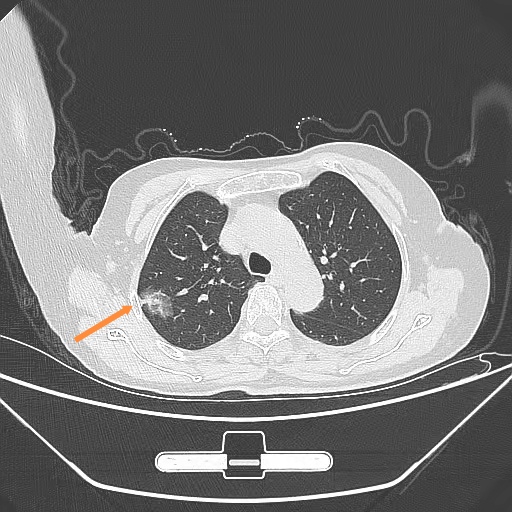 刘女士62岁,反复咳嗽咳痰一年, 少量白痰,痰中没有血丝