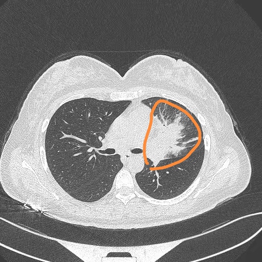 这种肺炎,死亡率40%