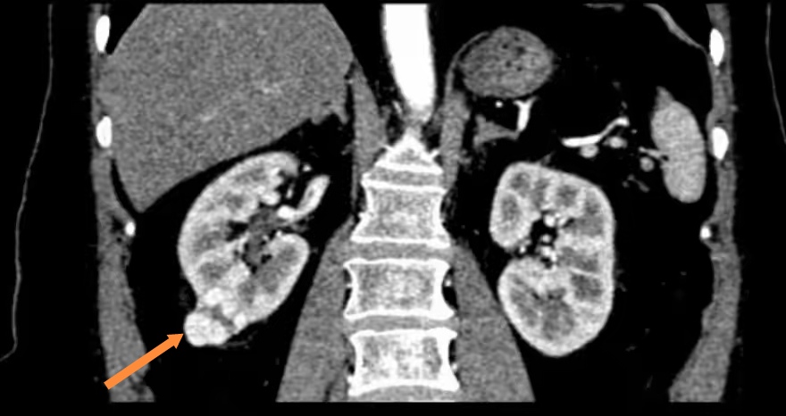 又住院做了增强ct,考虑肾癌