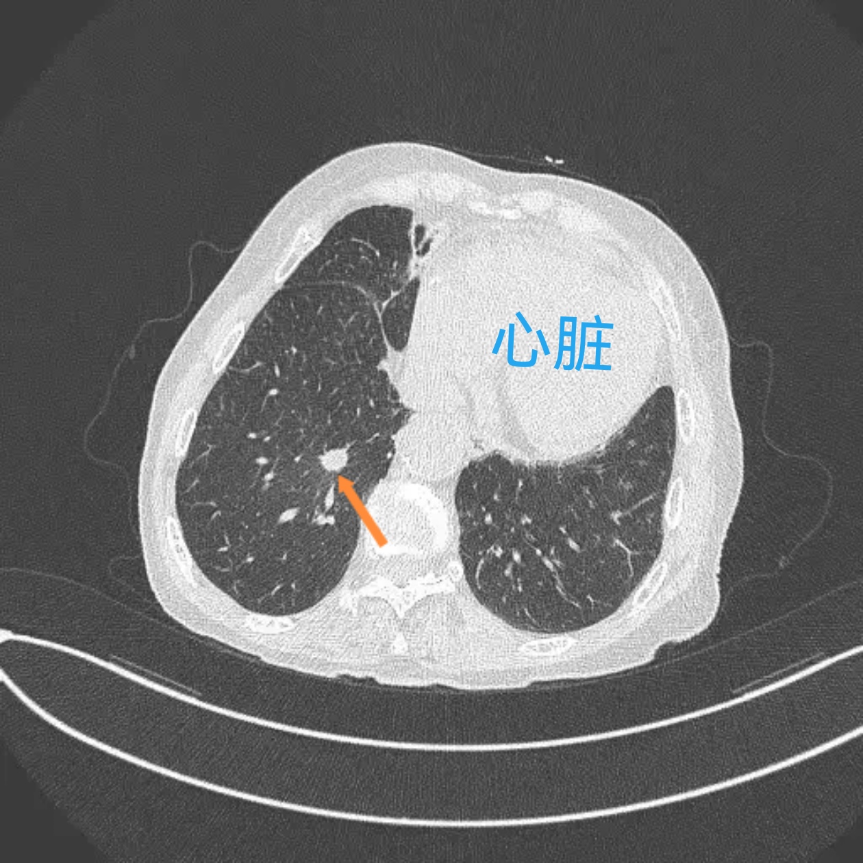 陈女士84岁, 咳嗽,胸闷一个月,ct查出1.2厘米的肺结节