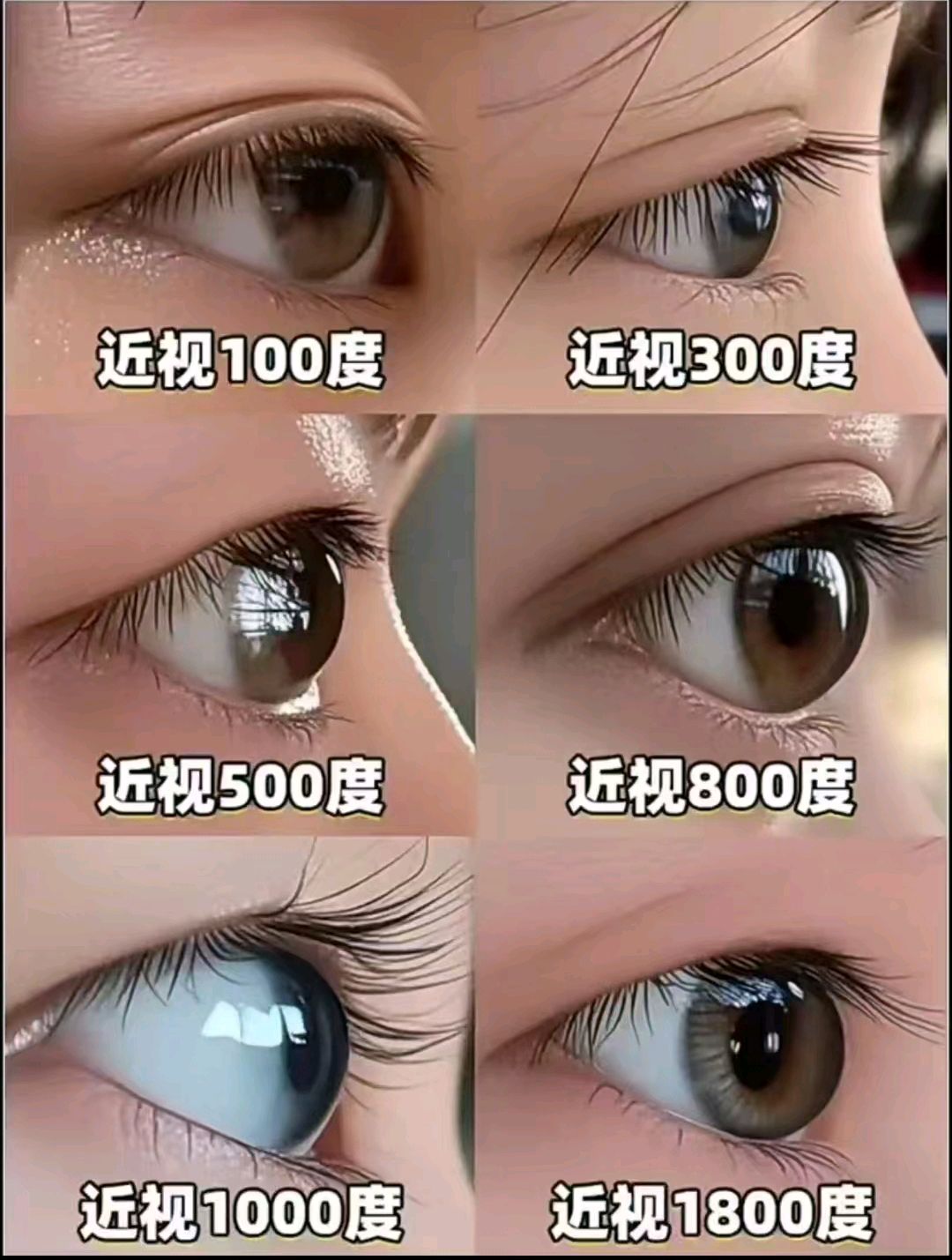 近视眼戴眼镜会使眼球变凸?