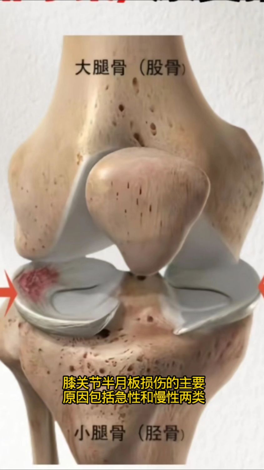 膝关节半月板损伤的原因