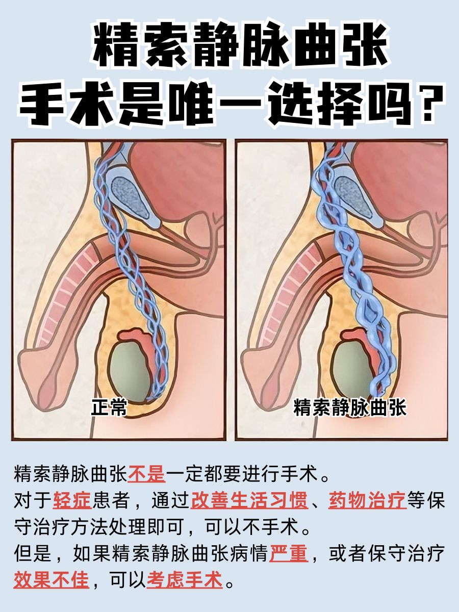 精索静脉曲张:除了手术,我们还有其他选择吗?