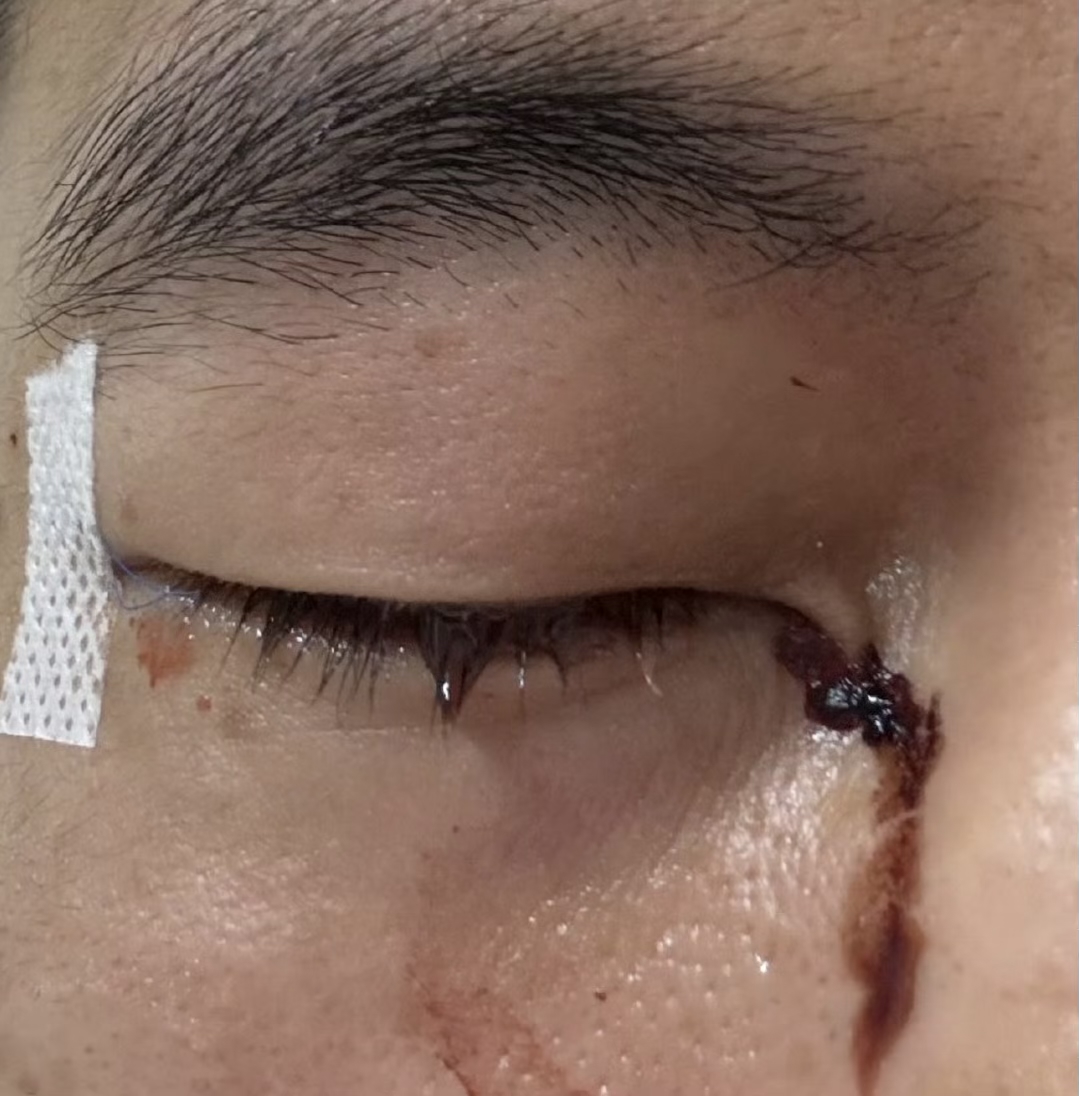 被队员用手指扎眼珠里,眼睛里缝了40多针,他公开眼部流血照片,"我不