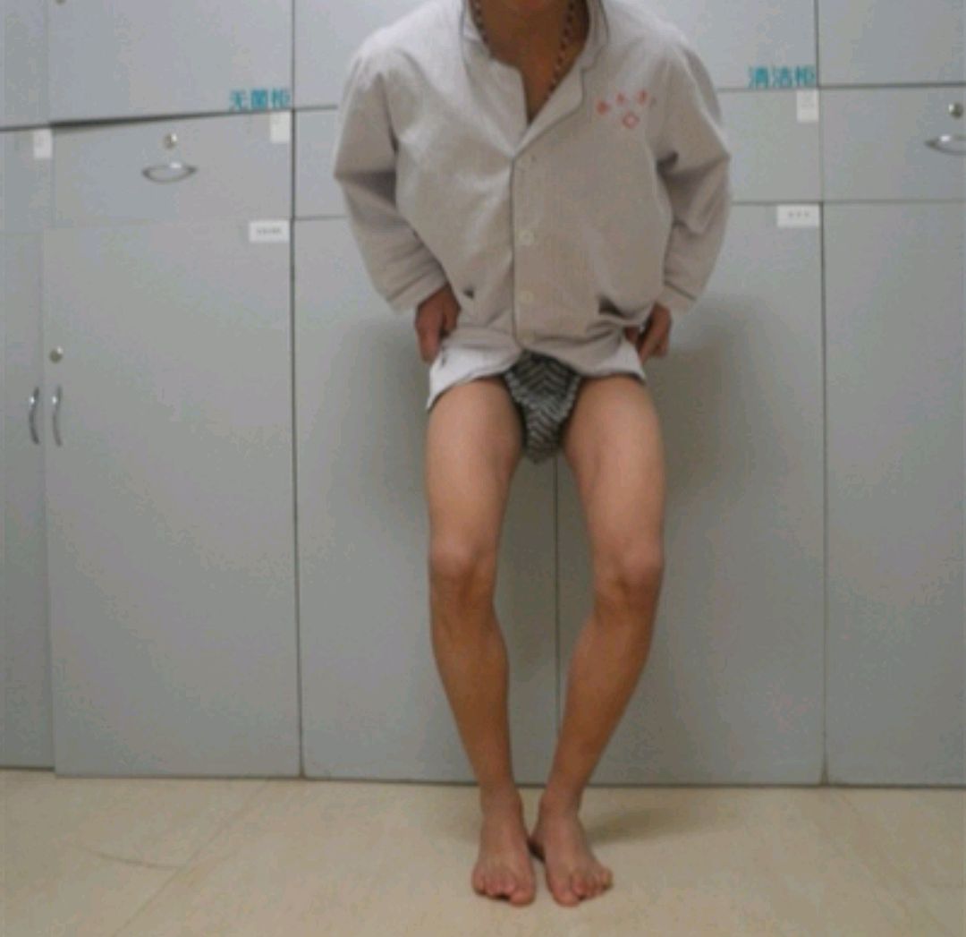 警惕臀肌挛缩症"找上门"!你可能正在忽视的隐形危机