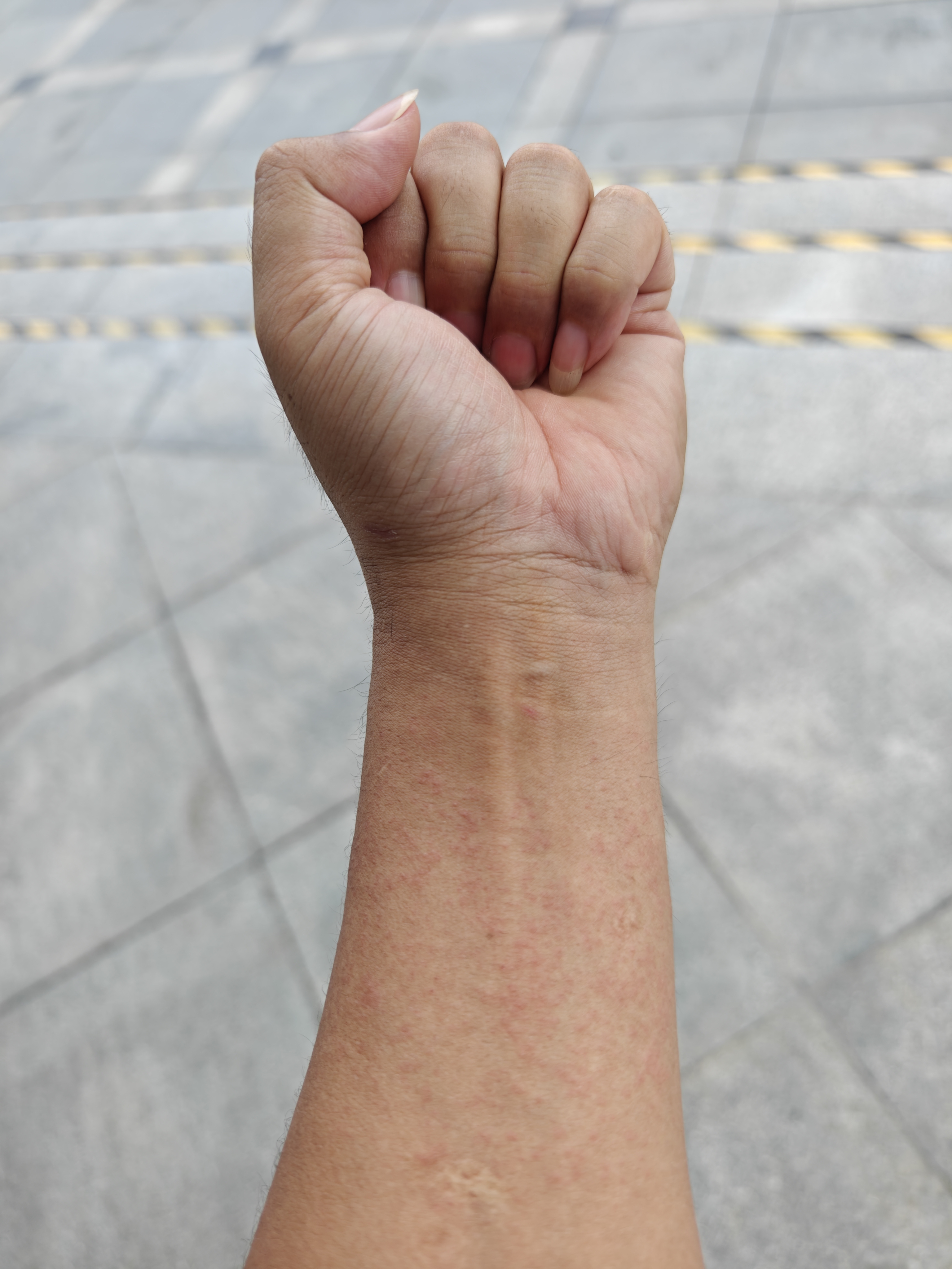 前几天去医院拿药包扎了一下手腕,一天后,手上包扎的皮肤过敏了,很痒