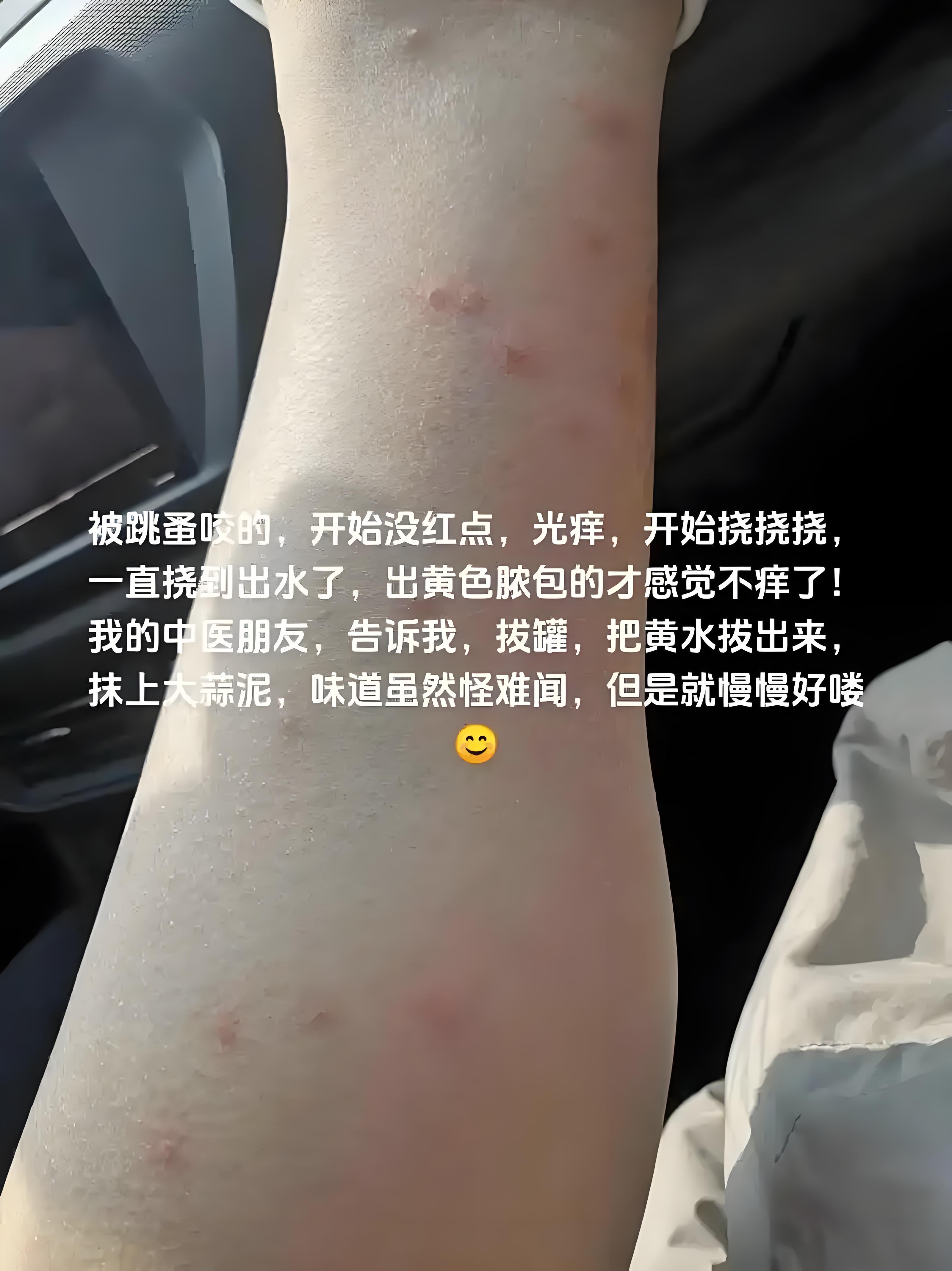 东莞一学校学生被跳蚤叮咬现在情况如何?
