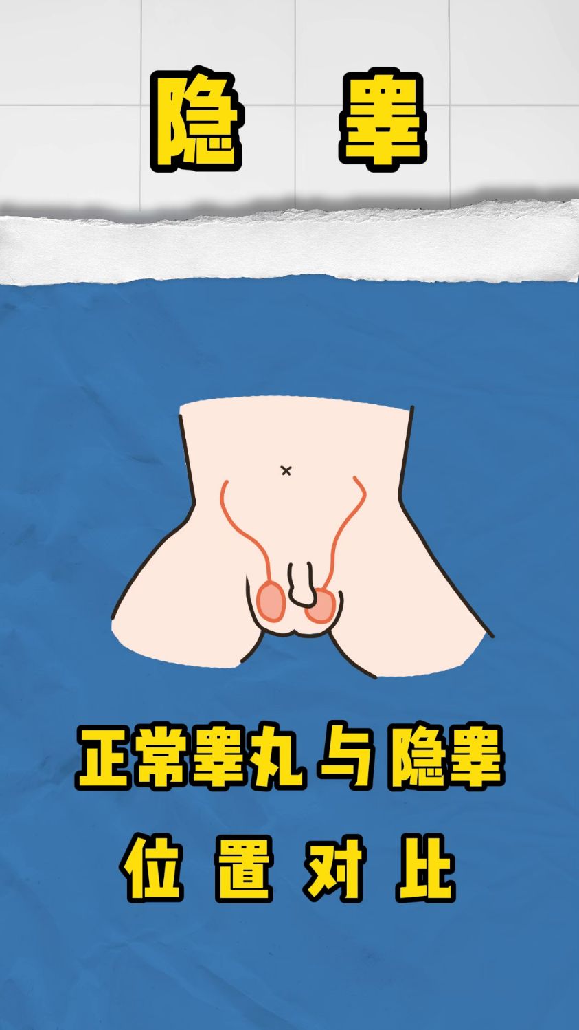 这种孩子患a几率比普通孩子高40倍!隐睾还有哪些危害?