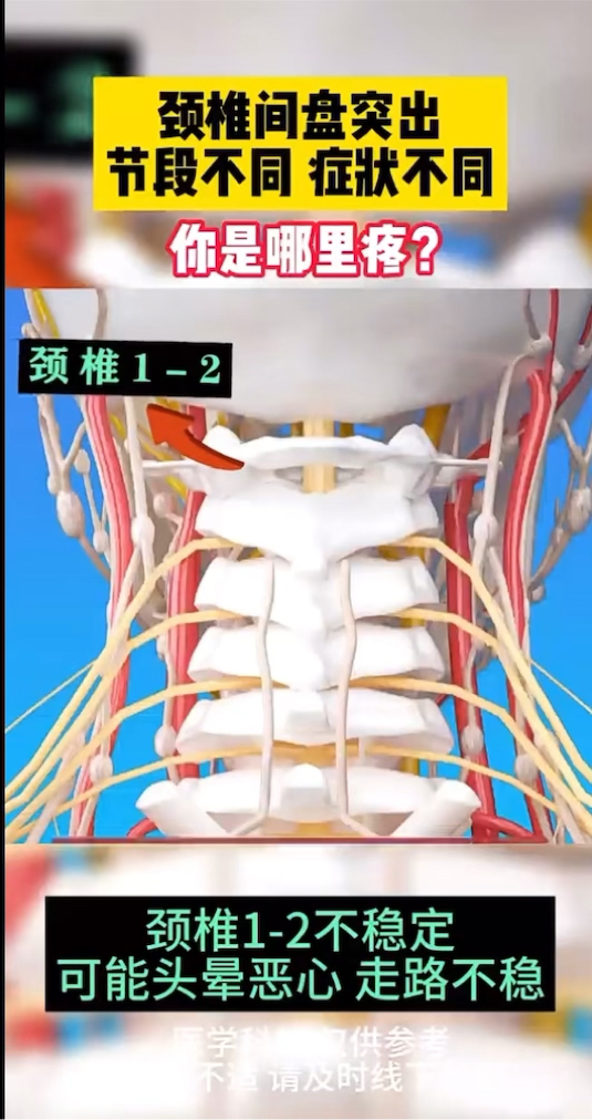 颈椎间盘突出,节段不同,症状不同