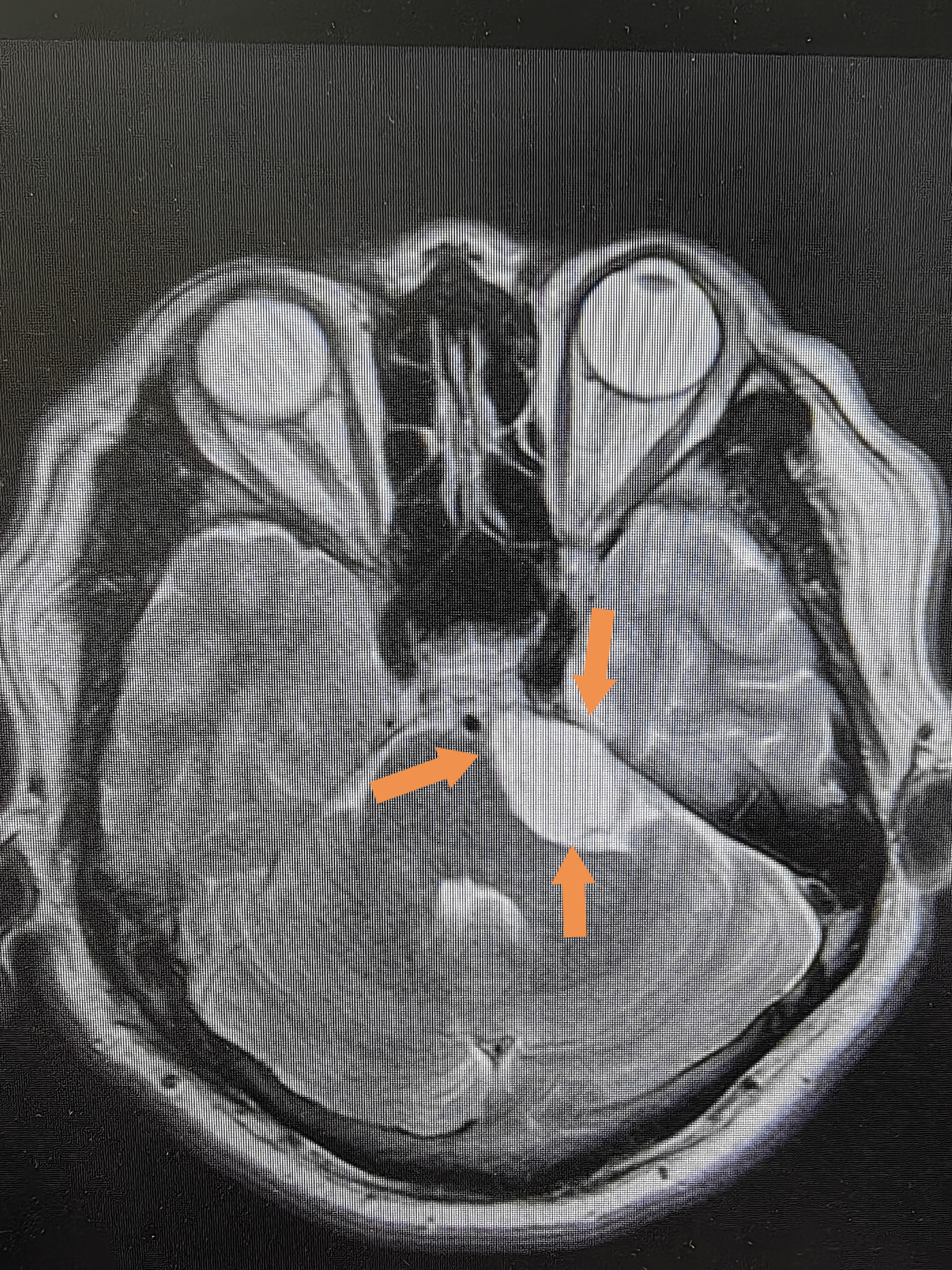 共振颅脑核磁影像有白色占位怎么办颅内肿瘤性病变mri诊断颅脑的正常
