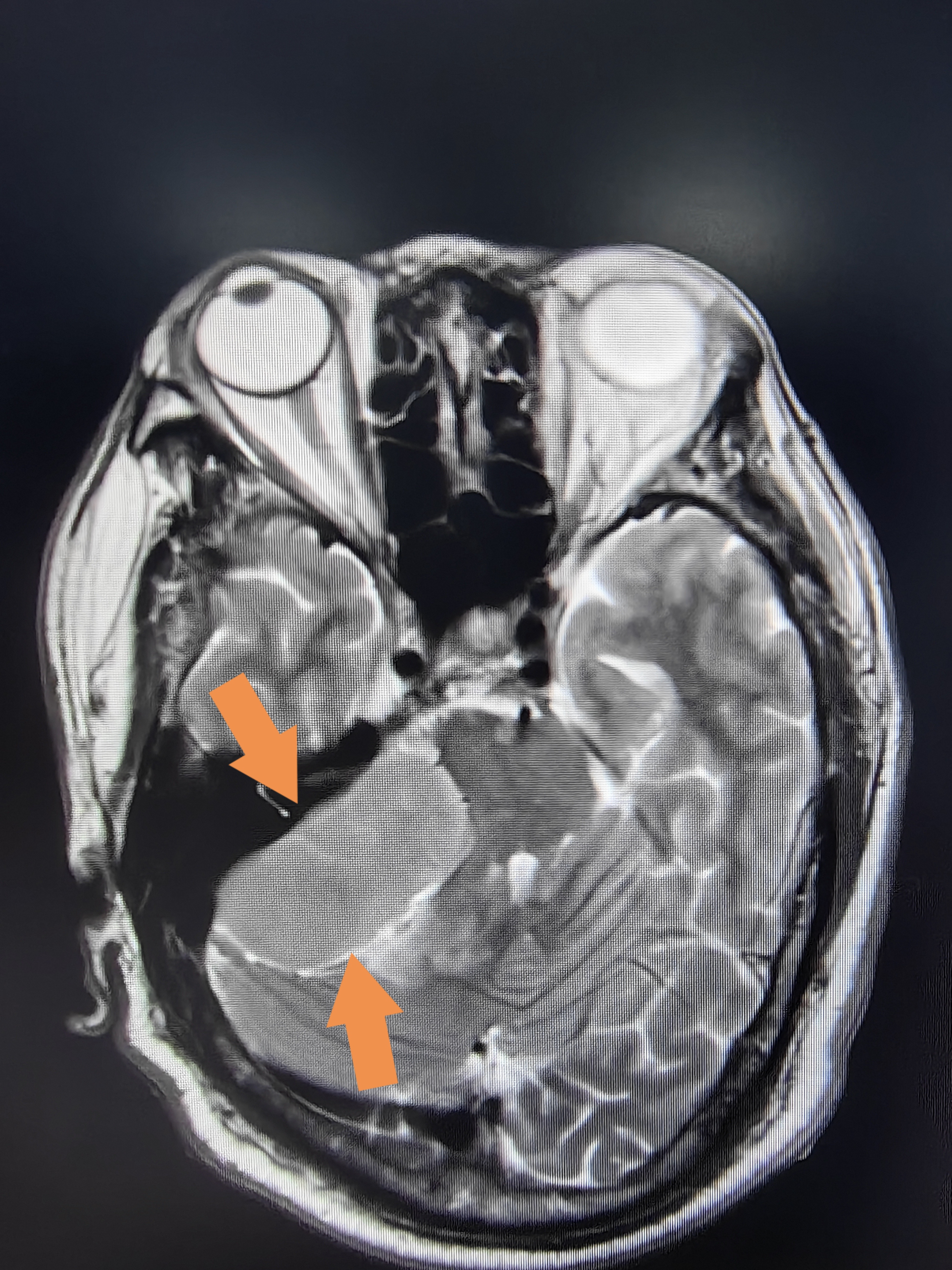 图片核磁脑部检查图片三叉神经肿瘤磁共振表现图片核磁共振检查图片