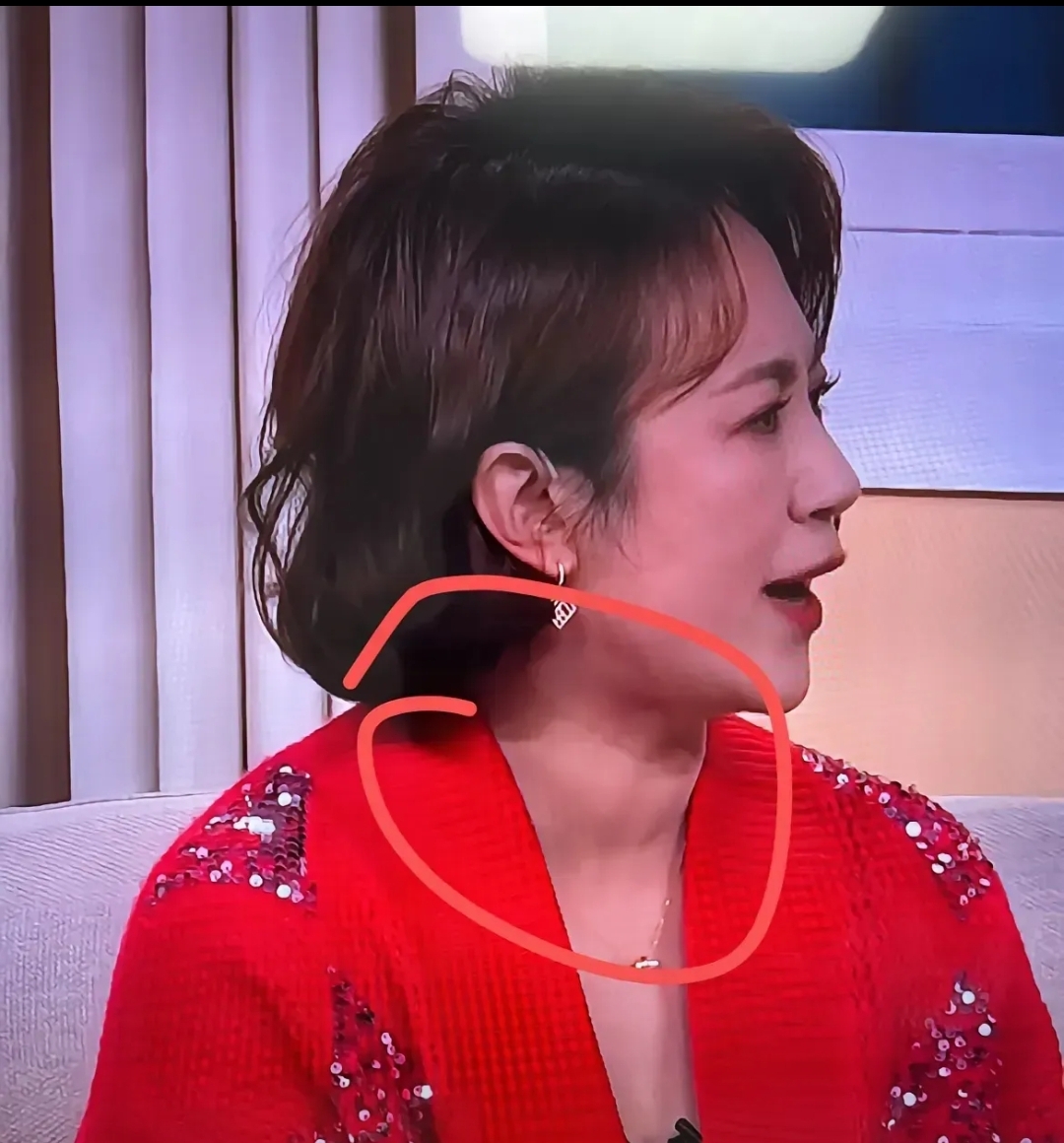 昨晚看春晚时候我就发现了马丽的脖子显得有些肿大我当时就在想