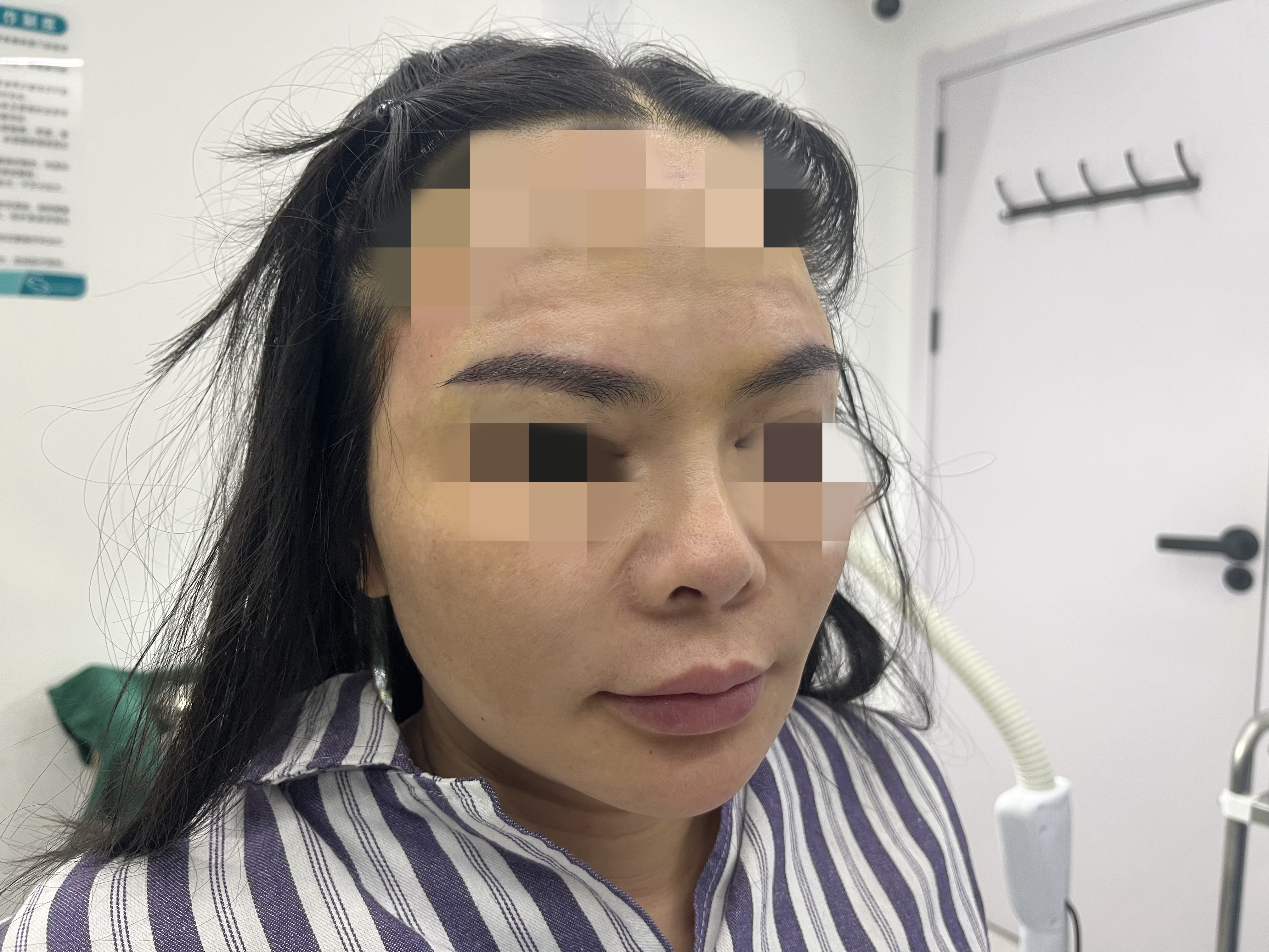 自体毛发眉毛移植