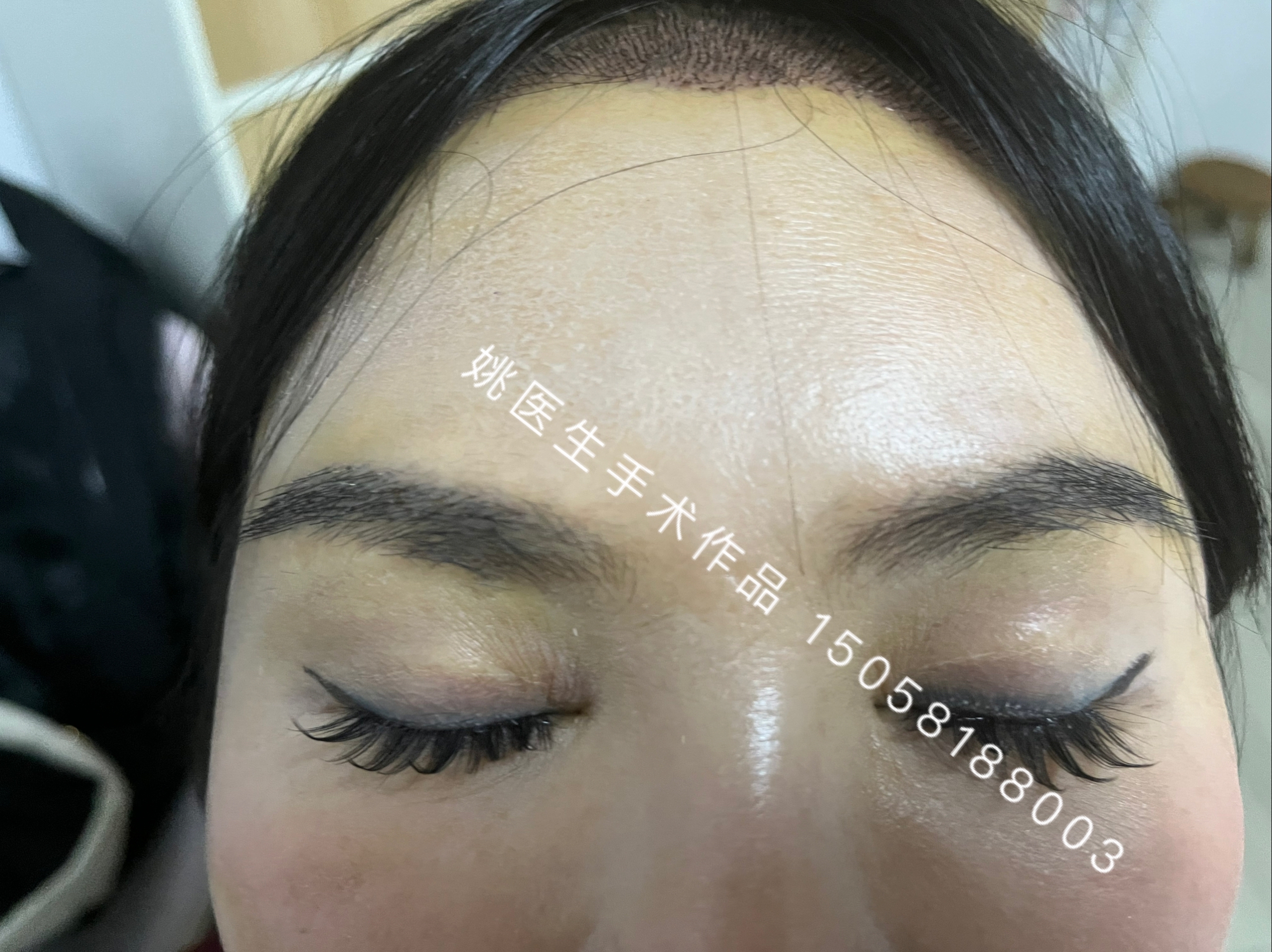 自体毛发眉毛移植