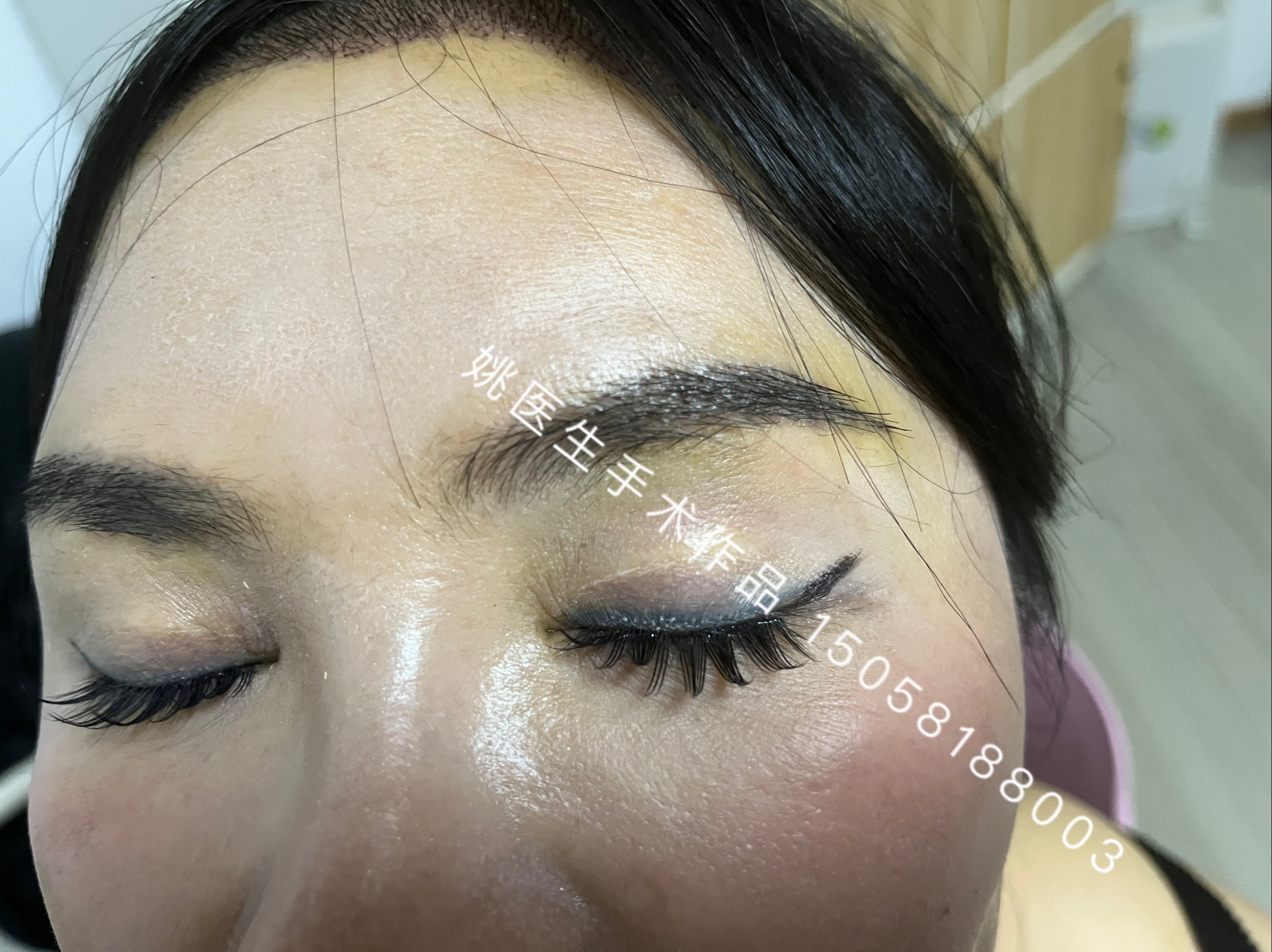 自体毛发眉毛移植