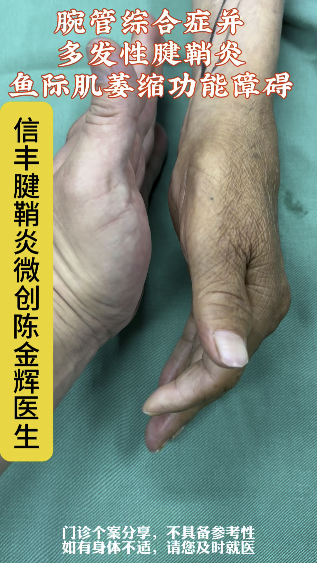 腕管综合征,合并多发性腱鞘炎鱼际肌萎缩嗯,功能障碍