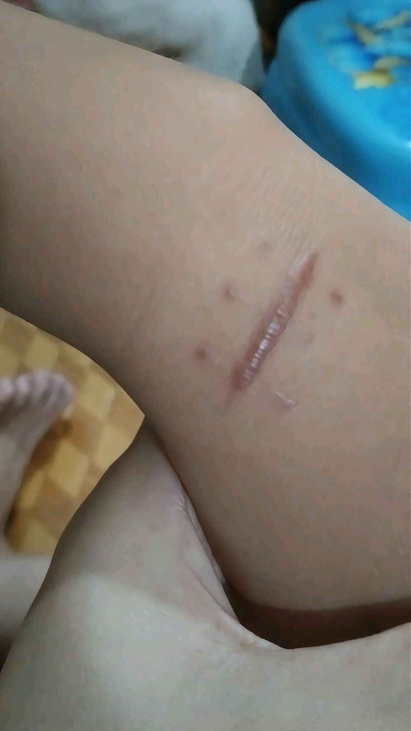 术后疤痕增生了怎么变平的过程