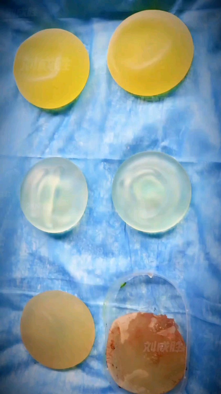 3对假体同天取出:包膜挛缩,美丽背后的"隐形杀手"!