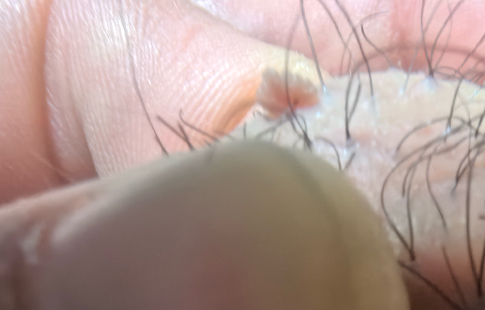 阴毛上小肉芽是尖锐湿疣吗?