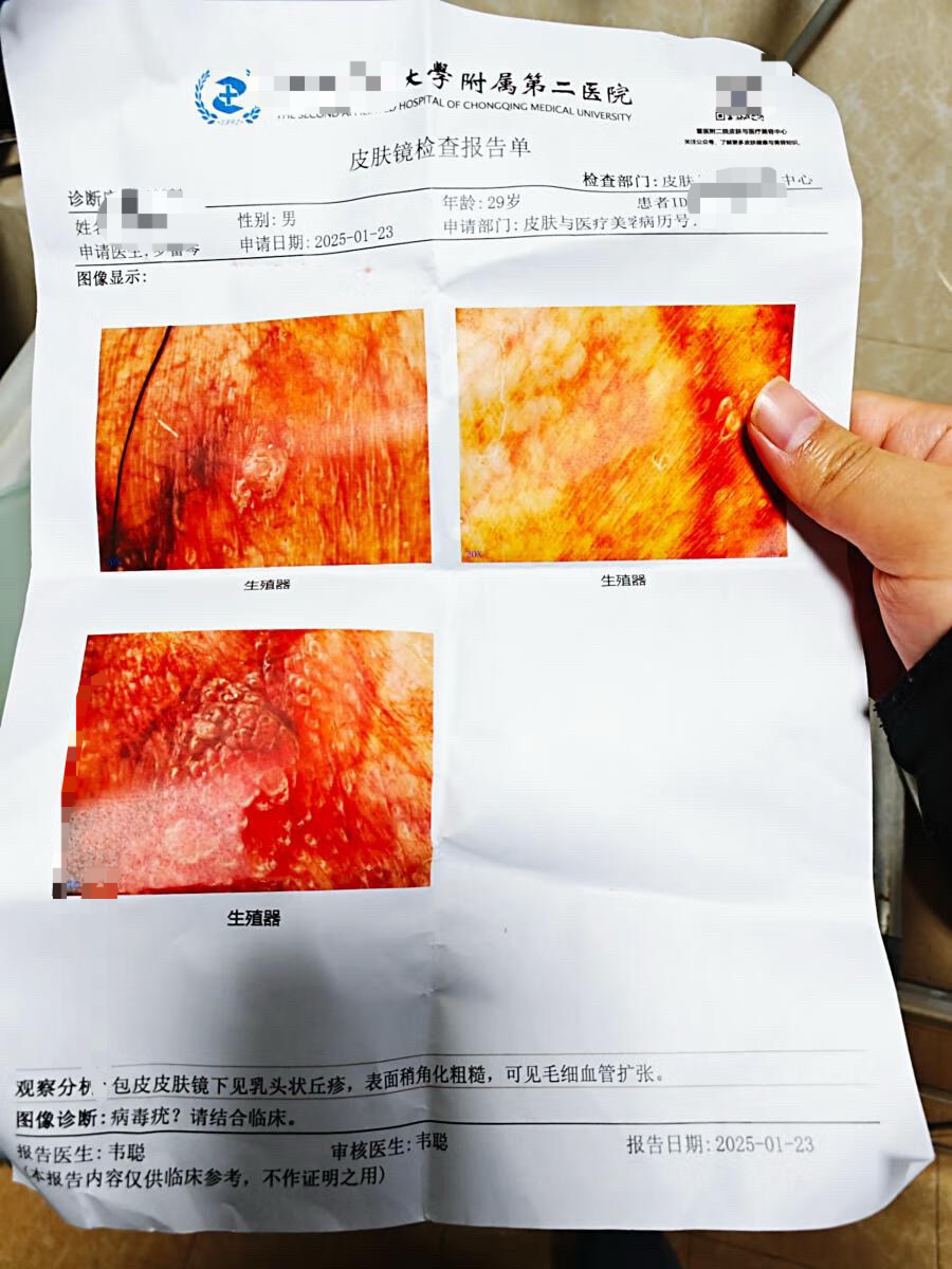 醋白实验阴性的也是尖锐湿疣吗?