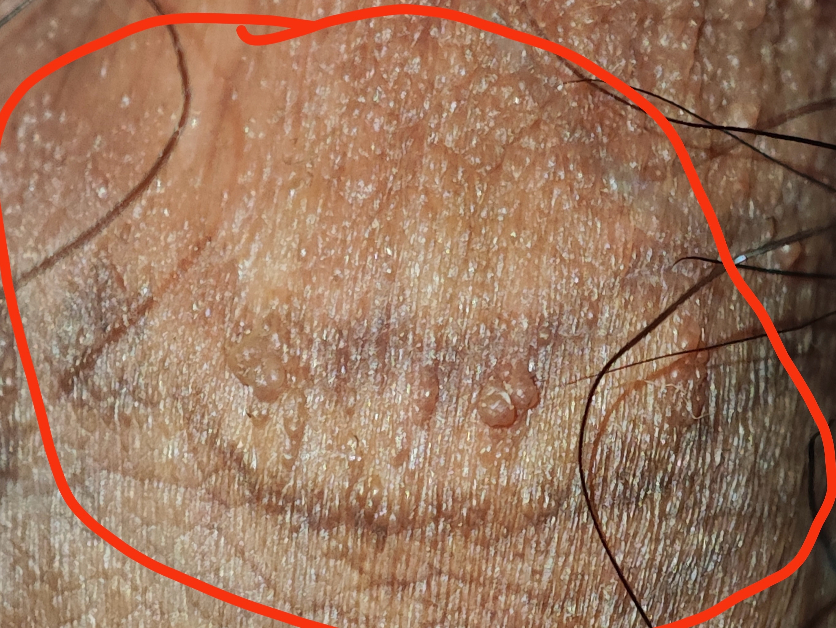 醋白实验阴性的也是尖锐湿疣吗?