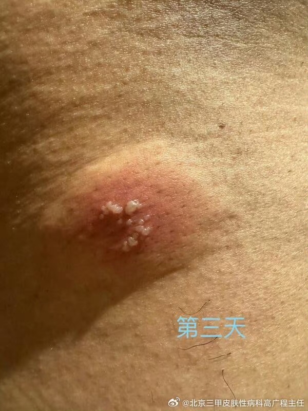 臀部长了几个水泡,曾经得过生殖器疱疹,和这个有关联么?