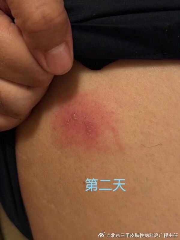 臀部长了几个水泡,曾经得过生殖器疱疹,和这个有关联么?