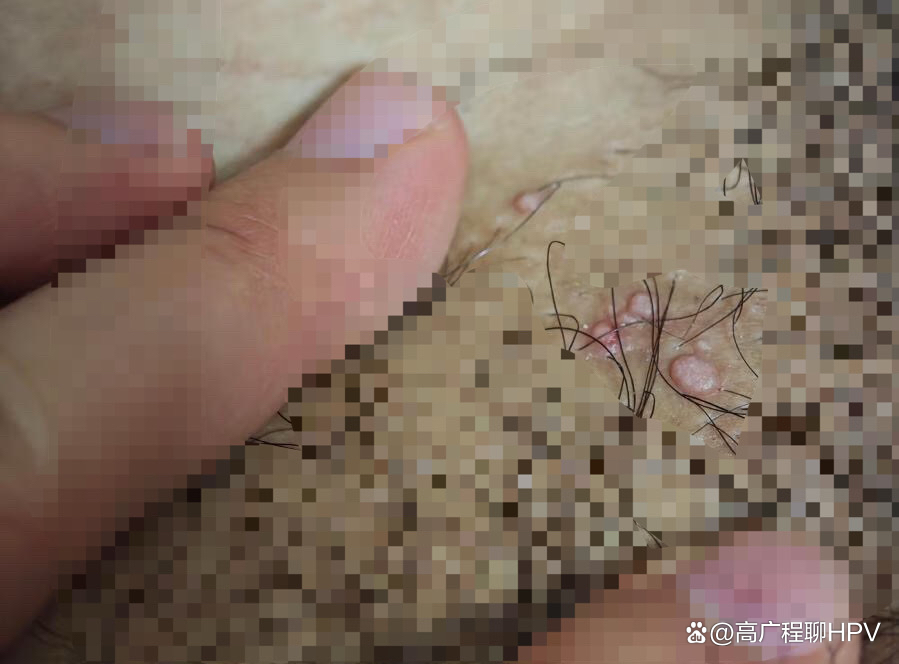 尖锐湿疣初期症状图片_(尖锐湿疣初期症状图片口腔) 尖锐湿疣初期症状图片_(尖锐湿疣初期症状图片口腔)