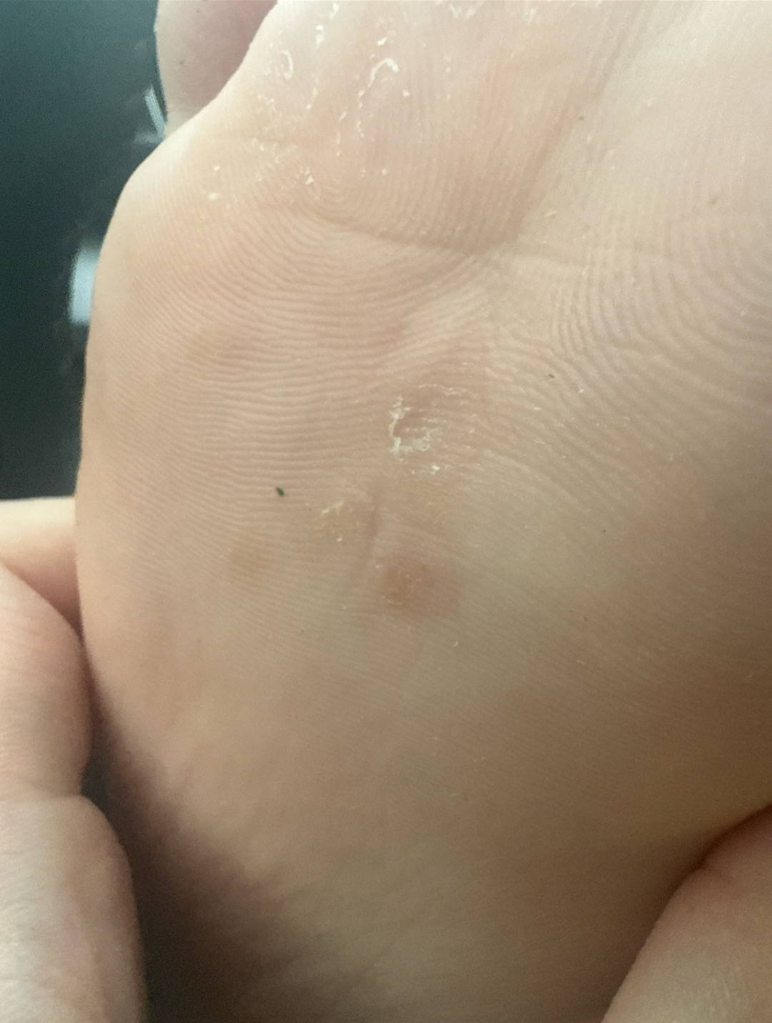 男34岁,手足皮疹,不痛不痒,怕是二期梅毒疹?