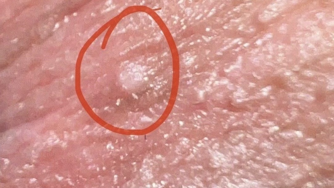 男,25岁,我这个地方有个白色的东西 ,是尖锐湿疣吗?