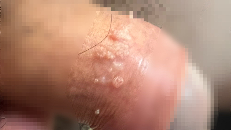 尖锐湿疣不治疗能自愈吗?