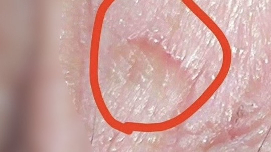 男,43岁,高主任您帮我看看,冠状沟位置,靠近系带位置,有没有不正常?