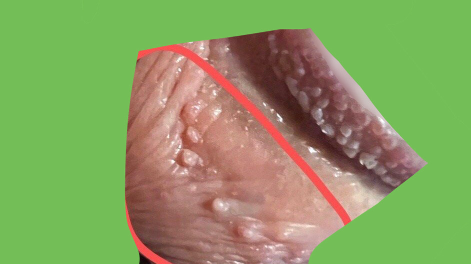 包皮冠状沟上的和冠状沟下端的是不是尖锐湿疣?