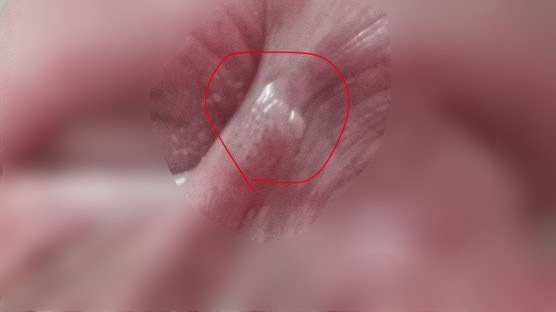 龟头系带增生物是尖锐湿疣吗?