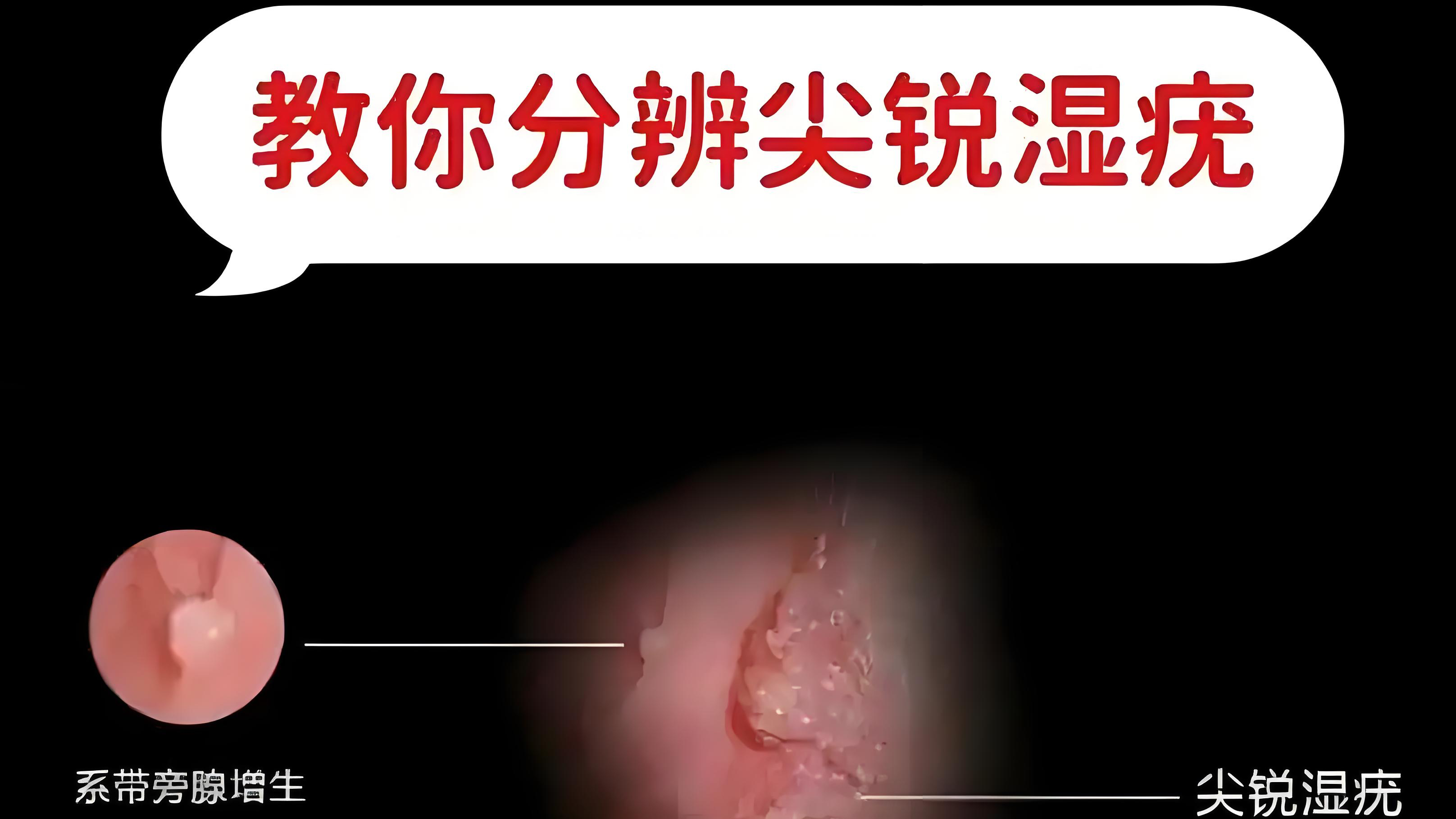 会传染吗?普通衣物会传染吗?