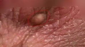 hpv43感染会引起阴囊结节瘙痒吗?